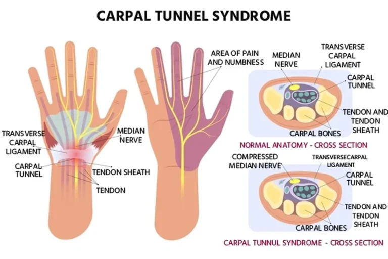 What Size Ergonomic Mouse Should You Buy for Carpal Tunnel in the UAE